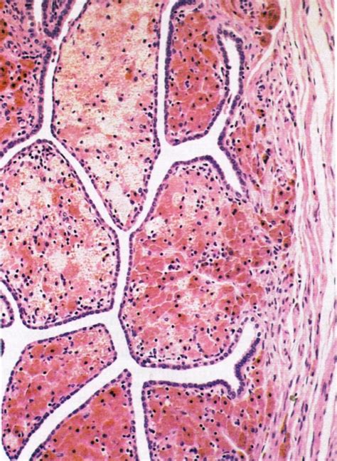 Pathology Outlines Chronic Salpingitis