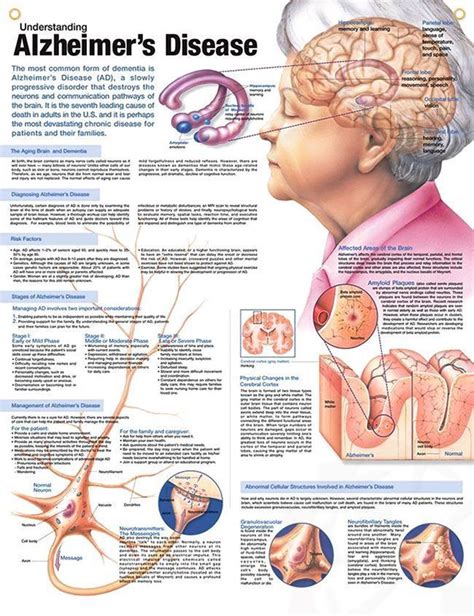 Understanding Alzheimer S Disease Chart 20x26 Infografia Alzheimer