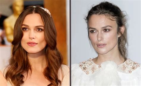 Female Celebrities with Hair Transplants – Before & After - Kopelman Hair