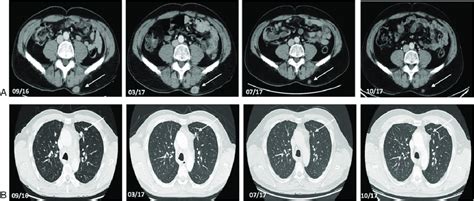 Axial Contrast Enhanced Ct Scan Of Abdomen And Chest Of A 49 Year Old Download Scientific