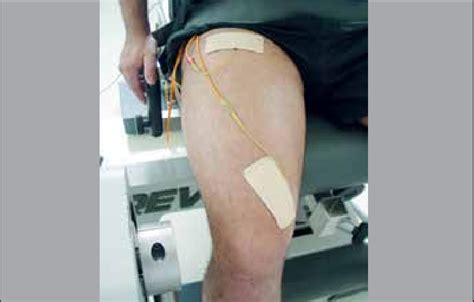 Placement Of Electrodes For Neuromuscular Electrical Stimulation