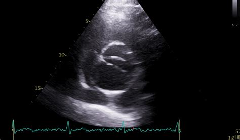 Strain Echocardiographic Diagnosis In Aortic Stenosis