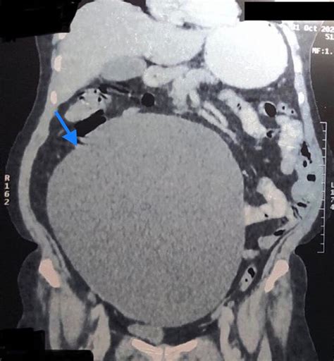 Ct Scan Of The Abdomen Showing A Large Ovarian Cyst Sagittal View