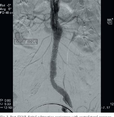 Pdf Repair Of Abdominal Aortic Aneurysms With Aorto Uni Iliac