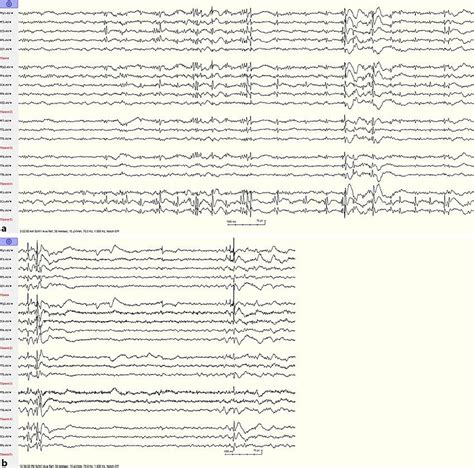 A Typical Electroencephalography Eeg During Stage 2 Non Rem Sleep