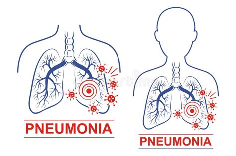 Pneumonia Disease Vector Icon Set Human Lungs Trachea Anatomy