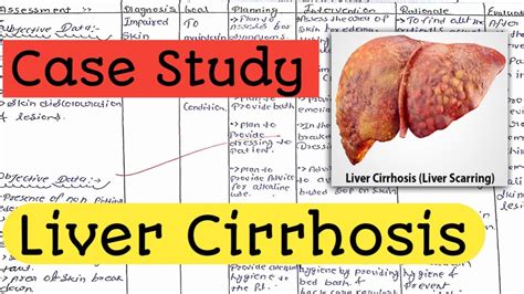 Case Study On Liver Cirrhosis Case Presentation Nursing Care Plan The