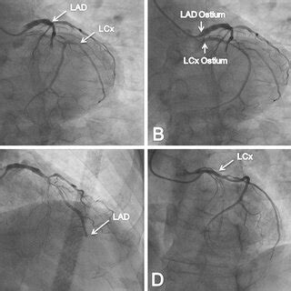 -Coronary angiography showing absence of left main coronary artery ...