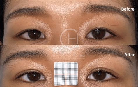 Non Incisional Double Eyelid Surgery 陳宏彰醫師