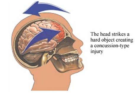 New Study Provides Insight Into Chronic Traumatic Encephalopathy