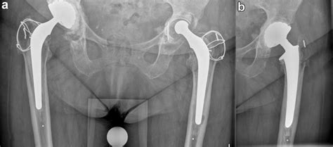 Asymptomatic Intraprosthetic Dual Mobility Cup Dislocation With