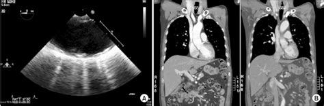 Follow­up Transesophageal Echocardiography A And Ct Angiography B Download Scientific