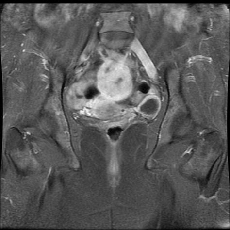 Uterine Leiomyoma Figo Type Vi Image