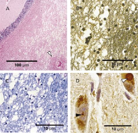 A Marked Spongiosis Of Deep Cerebellar White Matter Is Seen In Case