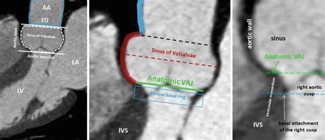 Left Ventricular Outflow Tract Radiology Key