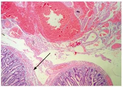 Diverticulosis Histology