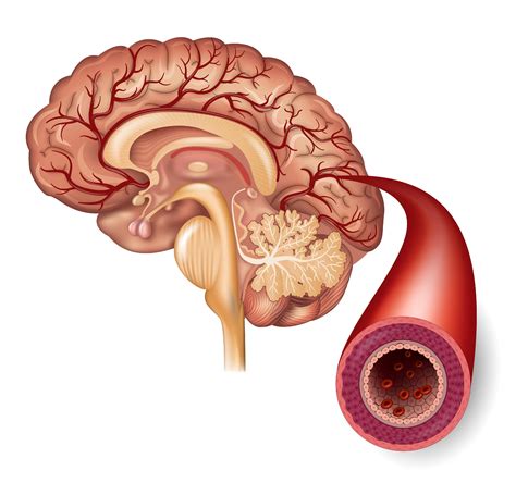 Transient Ischemic Attack | TIA | Mini-stroke| MedlinePlus
