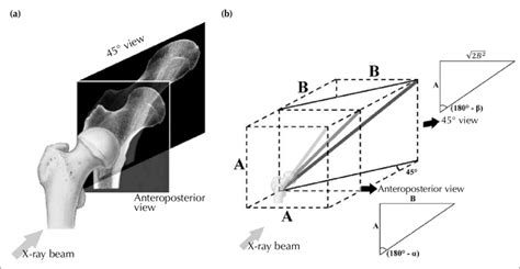 a Lateral 45º oblique projection of the X ray beam distorts the