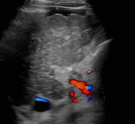 Abdomen and retroperitoneum | 1.1 Liver : Case 1.1.12 Cirrhosis and ...