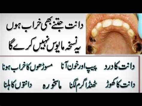 Tooth Care Tips Tooth Cavity Treatment Dant Dard Ka Ilaj In