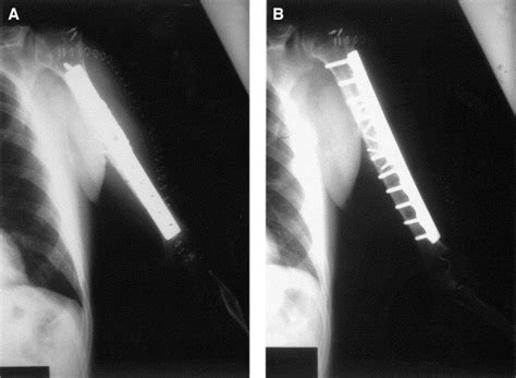 Internal Jugular Deep Venous Thrombosis After Surgical Treatment Of A