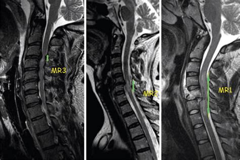 Hyperextension Cervical Spine Injuries And Traumatic Central Cord