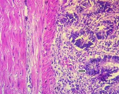 Proventriculus section showing prominent lymphoid proliferation with ...