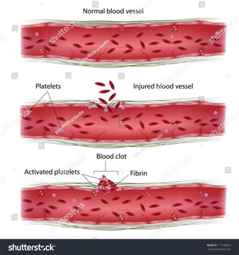 3,368 Injury To A Blood Vessel Images, Stock Photos & Vectors ...