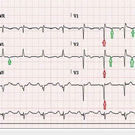 EKG During Follow Up Showing Pathological Q Waves Red Arrow And