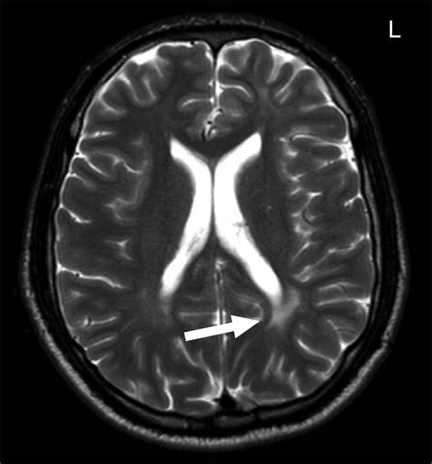 T2 Weighted Magnetic Resonance Image Of A 31 Year Old Female Patient