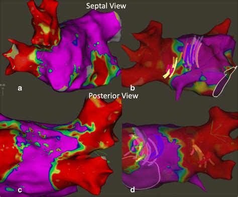 Antral Isolation Of The Right Pulmonary Veins Funnel Shaped Ostia And