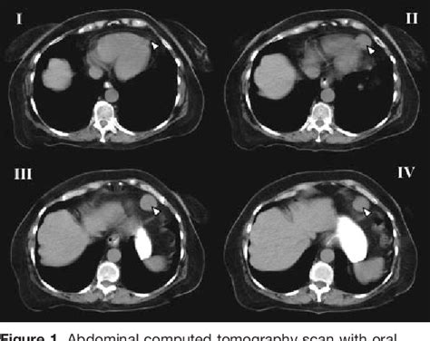 Figure From Images In Cardiovascular Medicine Right Ventricular