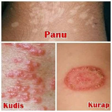 Apa Yang Anda Perlu Tahu Mengenai Scabies Pada Kucing Dan Jenis Kurap