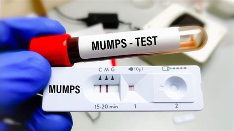 As New Jersey investigates mumps outbreak, experts share what to know ...