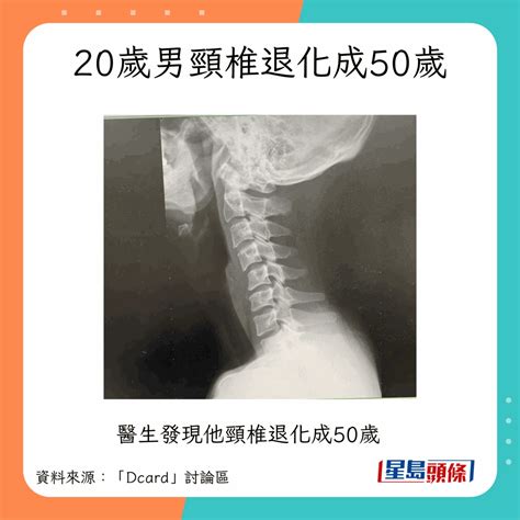 椎间盘突出｜20岁男颈椎退化成50岁 揭1姿势致椎间盘突出险变瘫 星岛日报