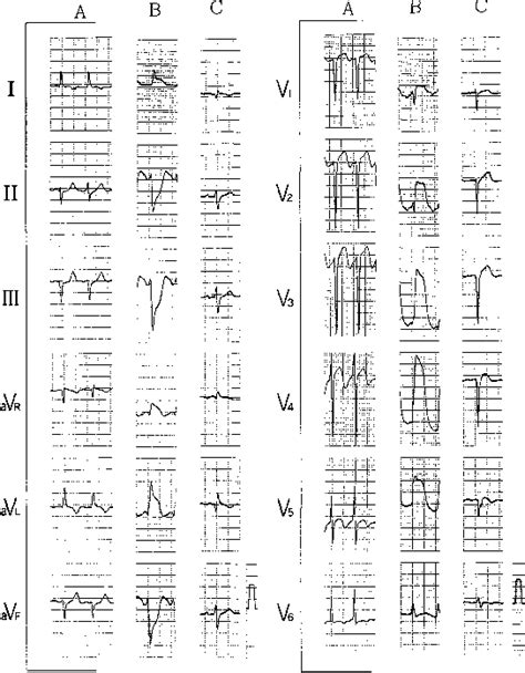 Figure 1 from Coronary artery spasm demonstrated by coronary ...