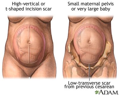 Pregnancy Health Center Vaginal Birth After C Section Vbac