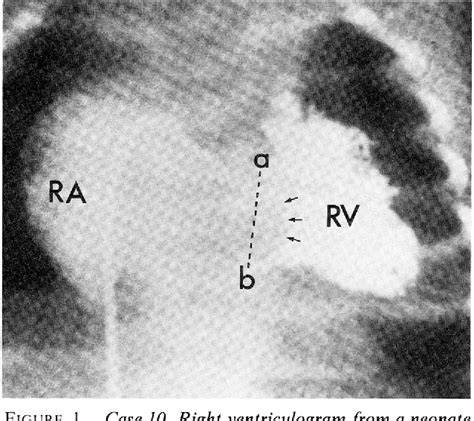 Table 1 From Right Ventricular Volume Determinations In 18 Patients