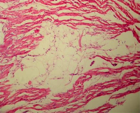 Fatty Infiltration In The Myocardium Of The Right Ventricle