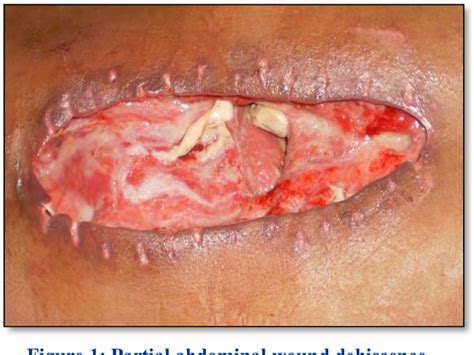 Figure From Study Of Burst Abdomen Its Causes And Management