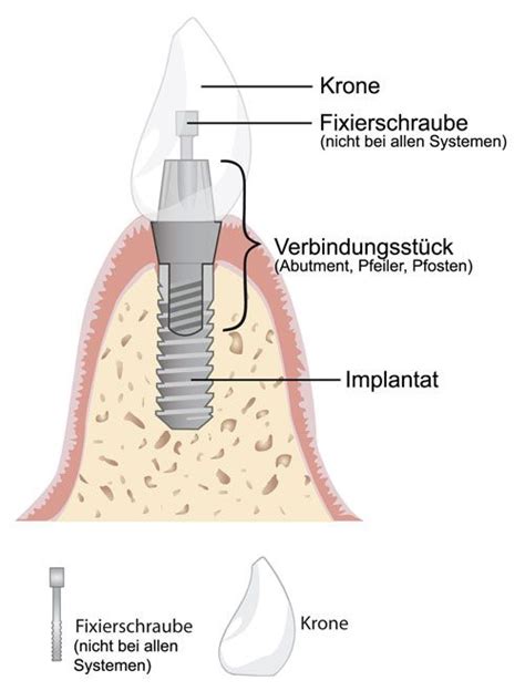 Was Ist Ein Implantat Zahnarzt Heidelberg Dr Bodem