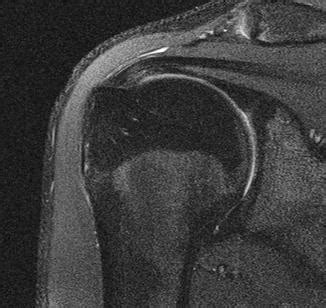 Normal Rotator Cuff Mri