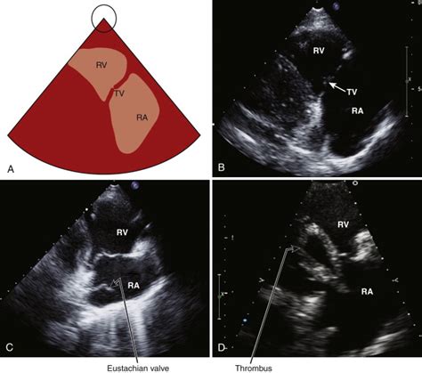 Echocardiography Radiology Key