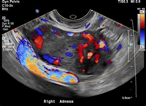 Case 3 | UW MEDICINE ULTRASOUND