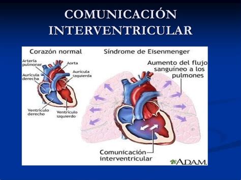 Comunicación Interventricular