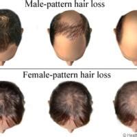 Male pattern alopecia (androgenetic alopecia) and female pattern alopecia