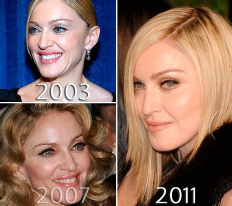 Madonna Plastic Surgery Before After Telegraph