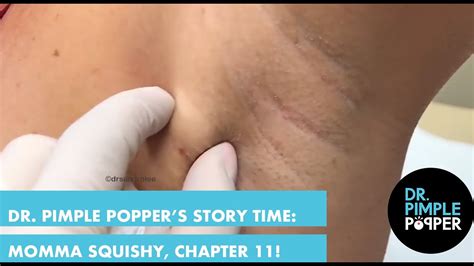 Dr Pimple Poppers Weekly Story Time Momma Squishy Chapter 11 Youtube