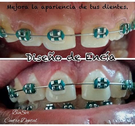 Est Tica Dental Gingivectomia Centro Dental Bioser