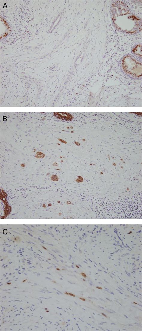 Low Grade Adenosquamous Carcinoma Of The Breast Journal Of Clinical